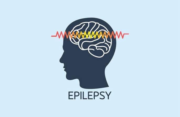 Epilepsy in Pakistan Causes, Prevalence, and Treatment