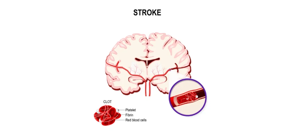 Stroke Patient aid foundation